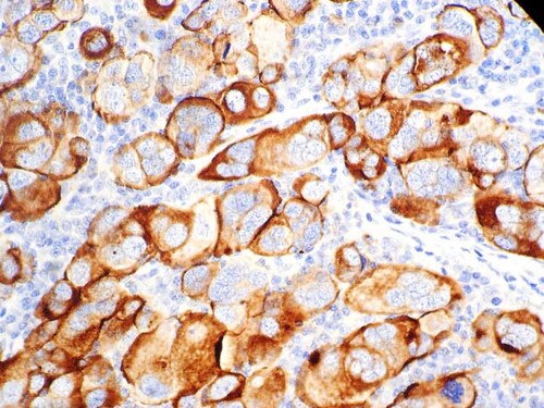 IHC of CA-125 on an FFPE Ovarian Carcinoma Tissue